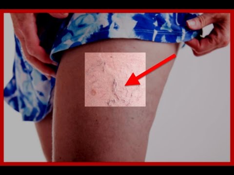 tranzacii pe revizuiri cu perei varicoi recenzii ale unui pelvis mic de varicoza
