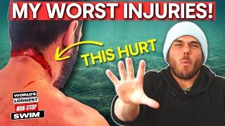 The WORST 5 Injuries: Long-Distance Swimming