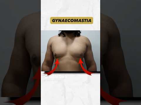 Gynecomastia Surgery Result