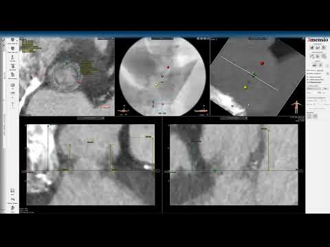 3Mensio CT Pre-case planning: Valve-in-Valve TAVR in Epic/Biocor