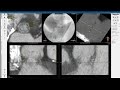 3Mensio CT Pre Case Planning Valve In Valve TAVR In Epic Biocor