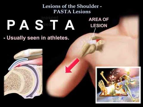 Lesions Of The Shoulder PASTA Lesions - Everything You Need To Know - Dr. Nabil Ebraheim
