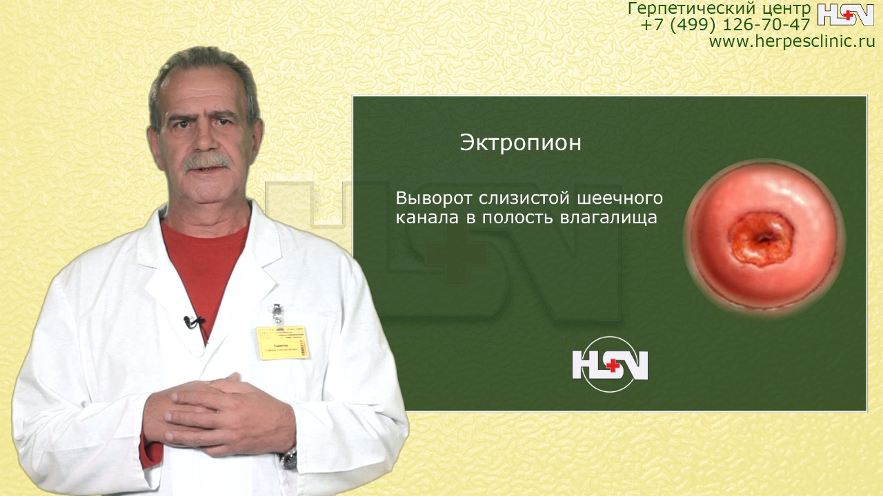 Эрозия шейки матки, эктропион, лейкоплакия