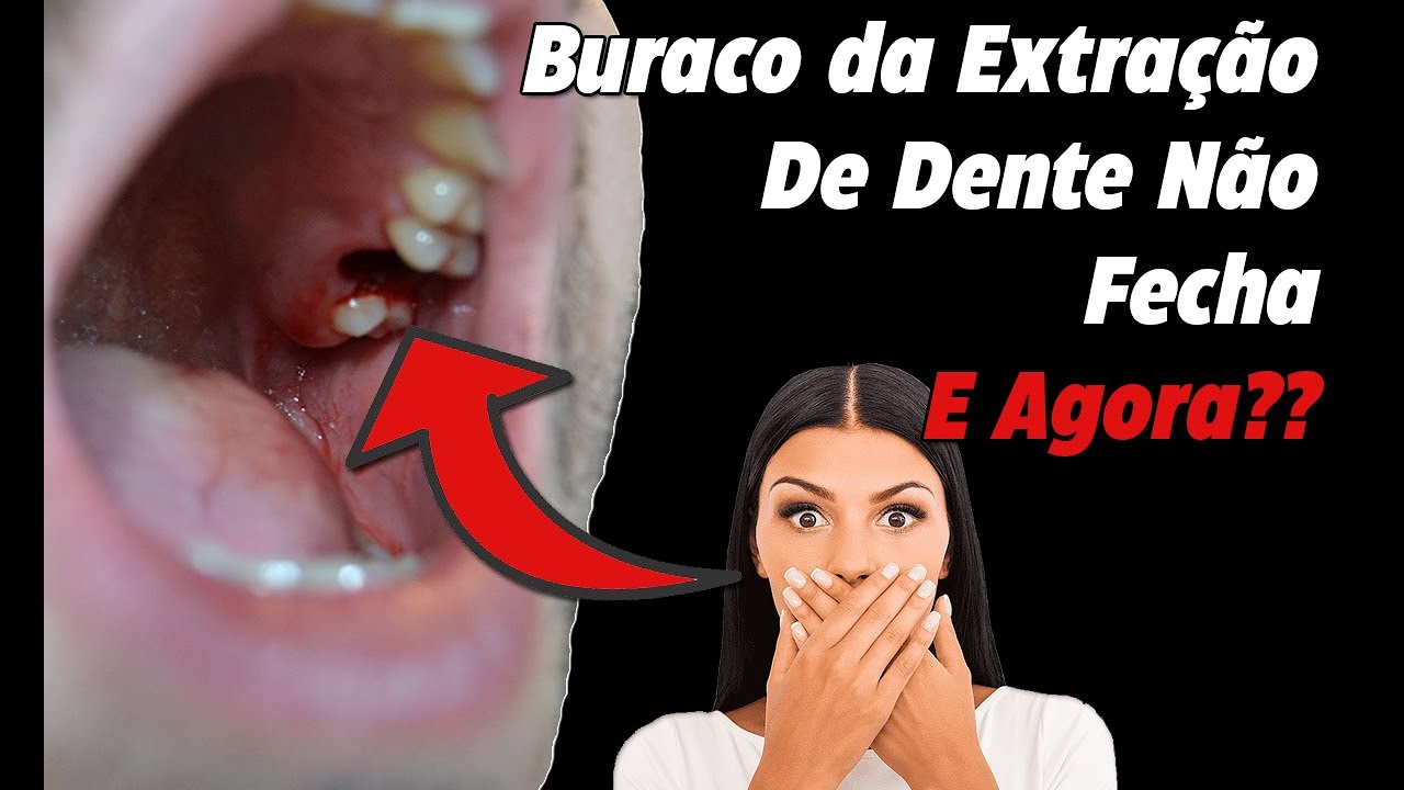 Tirei os Pontos da Extração de Dente e o Buraco Ficou Aberto – E Agora