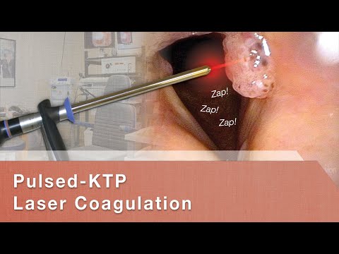 Pulsed-KTP Laser Coagulation of Vocal Cord Papillomas (RRP) Video