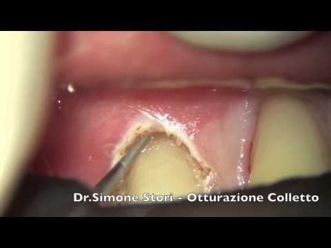 Osteocondrosi cervicale C5-C6 Agente anti-infiammatorio per le articolazioni tablet