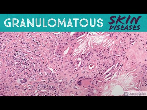 Granulomatous Skin Diseases 101: Dermpath Basics for Dermatology Pathology & USMLE