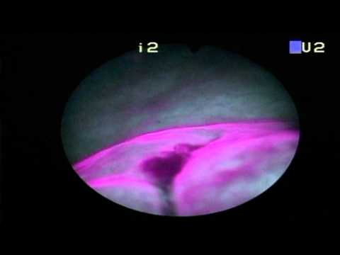 Analyse für Chirurgie an der Prostata-Adenom Prostata-Operation und Komplikationen