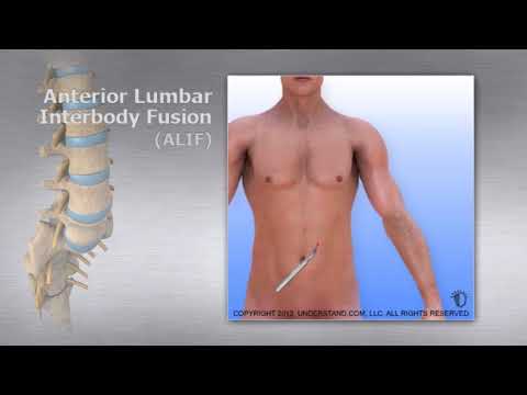 Lumbar   Anterior Lumbar Interbody Fusion ALIF