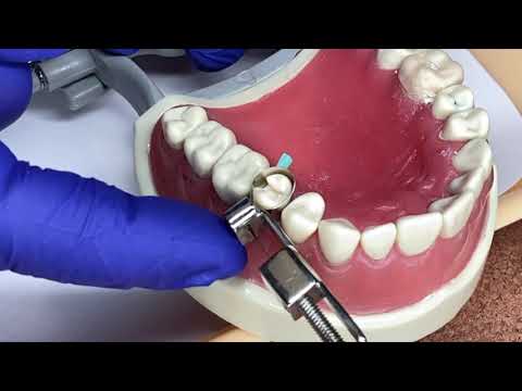 How to Assemble and Place a Tofflemire Matrix Band