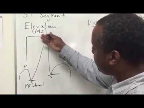 S T Segment Elevation vs S T Segment Depression