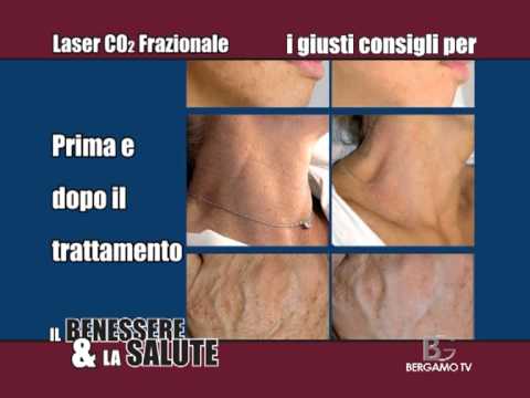 La canzone su lentiggini alla ragazza una traccia di sostegno Quello che lolio aiuterà da posti di pigmentary