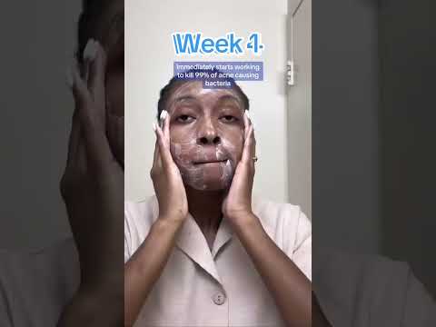 Before & After Skin Transformation with Differin's 10% Benzoyl Peroxide Foaming Cleanser