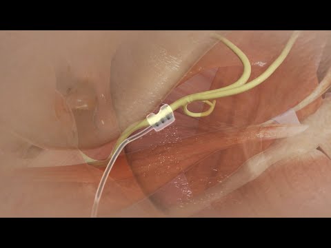 Hypoglossal Nerve Stimulator Device Implantation