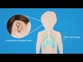 Microtia Surgery For Ear Reconstruction