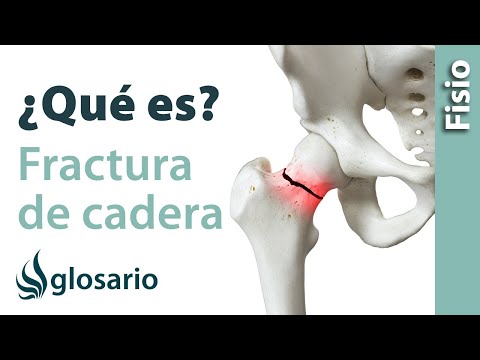 FRACTURA DE CADERA | ¿Qué es?
