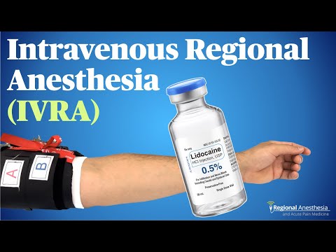 IVRA (Intravenous Regional Anesthesia): Theory, tips and tricks