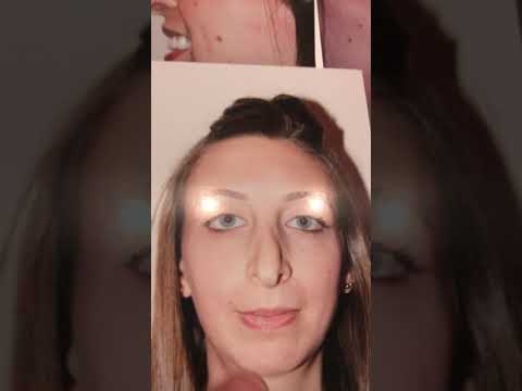 Watch Video: Revision Rhinoplasty leaves Dr. Sam Rizk’s patient happy