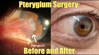 Ptergyium  Surgery - Before and After.  What is it?  How we remove it.  Recovery and Results.