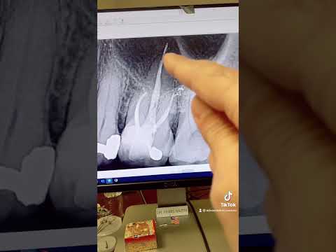 Does gutta percha extrusion cause endodontic failure?!