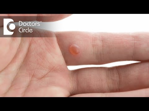 What are warts or skin tags? - Dr. Urmila Nischal