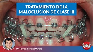 Tratamiento de la maloclusión de clase III
