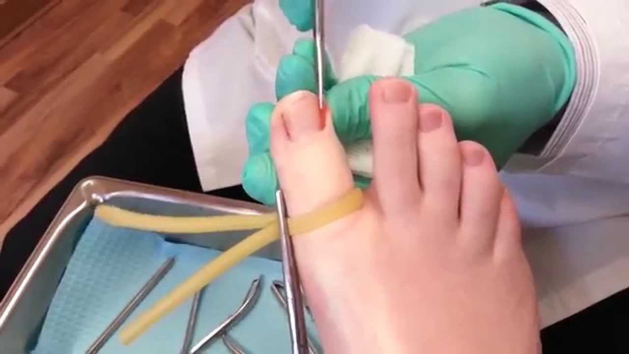 Partial nail avulsion, Ingrown Toenails | Ingrown toenail surgery | Dr  Naziya khatun nail surgery - YouTube