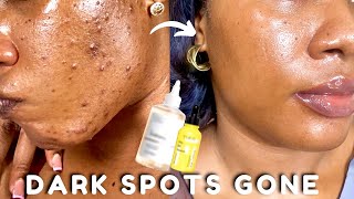 How I Cleared My Dark Spots and Hyperpigmentation