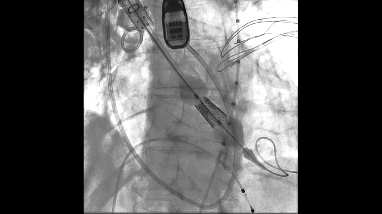 TAVR-Transcatheter Aortic Valve Replacement: Transaortic Deployment