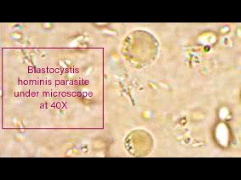 Blastocystis hominis bél paraziták