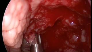 Adenoidectomie endoscopică - Dr. Bogdan Mocanu
