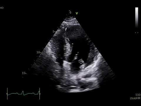 Four chamber view showing ejection fraction of 62% and resting tachycardia