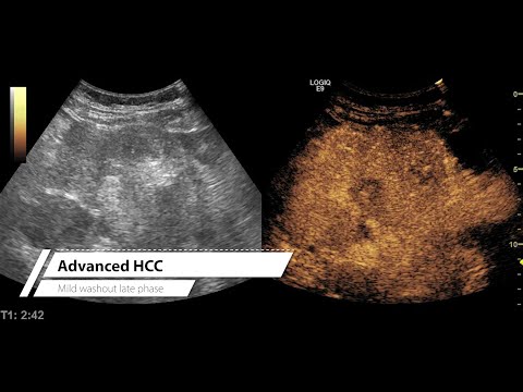 Let's learn CEUS #002 - advanced HCC