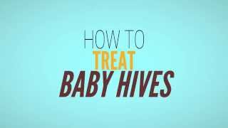 Baby Hives -  How to Get Rid of Hives in Babies and Toddlers