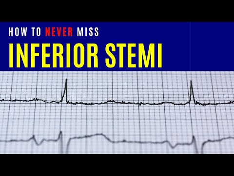 How to never miss Inferior STEMI