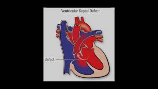 Clinical :CVS (VSD )