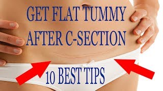 10 Best Tips To Get Flat Tummy After C Section!