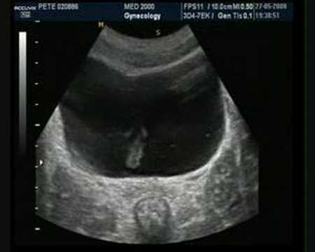 BPH 2 gradi per trattare Candele diclofenac con prostata
