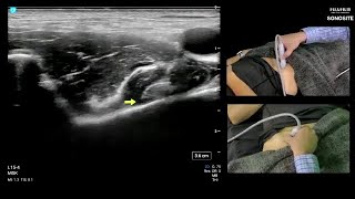 Ultrasound-Guided PENG and FICB Blocks for Hip Surgery