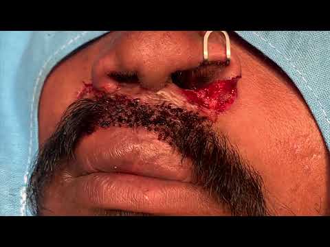 Nose Narrowing Or Re Contouring Surgery