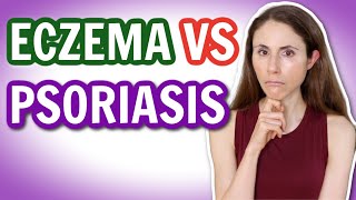 ECZEMA VS PSORIASIS: HOW TO TELL THE DIFFERENCE 🤔 @DrDrayzday