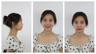 Class 2 cases of crowding, facial deviation and occlusal plane canting