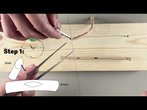 End-to-Side Vascular Anastomosis (distal CABG)