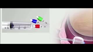 Inducción del parto con catéter de doble balón (cuff).