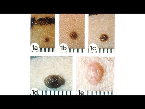 download lagu mp3 mp4 Mole Getting Lighter, download lagu Mole Getting Lighter gratis, unduh video klip Mole Getting Lighter