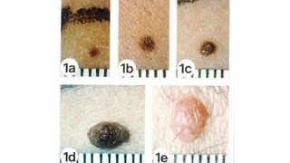 Skin Cancer & Raised or Elevated Moles | Skin Cancer