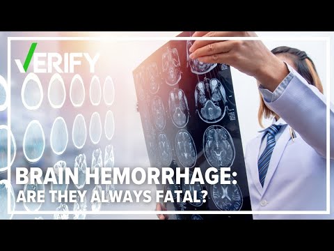 No, a brain hemorrhage is not always fatal