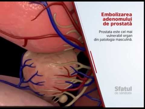 Chronic prostatitis treatment duration