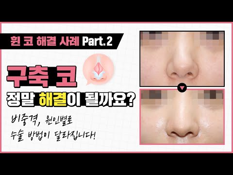 원인별 휜 코 해결 사례, 구축 코도 문제없이 해결할 수 있습니다!