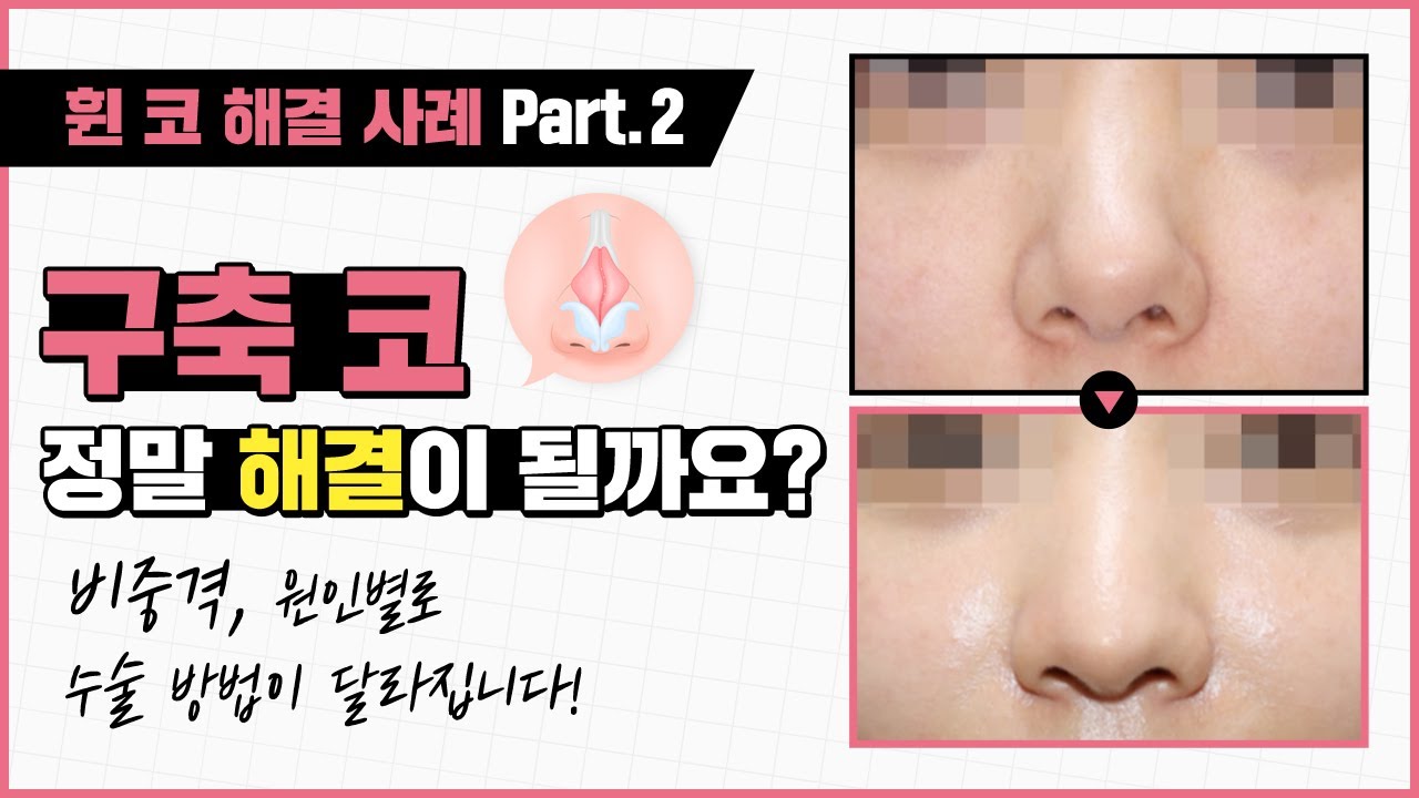 원인별 휜 코 해결 사례, 구축 코도 문제없이 해결할 수 있습니다! 썸네일